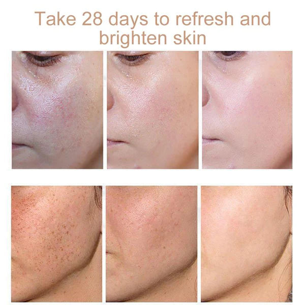 Face Freckle Removal Cream